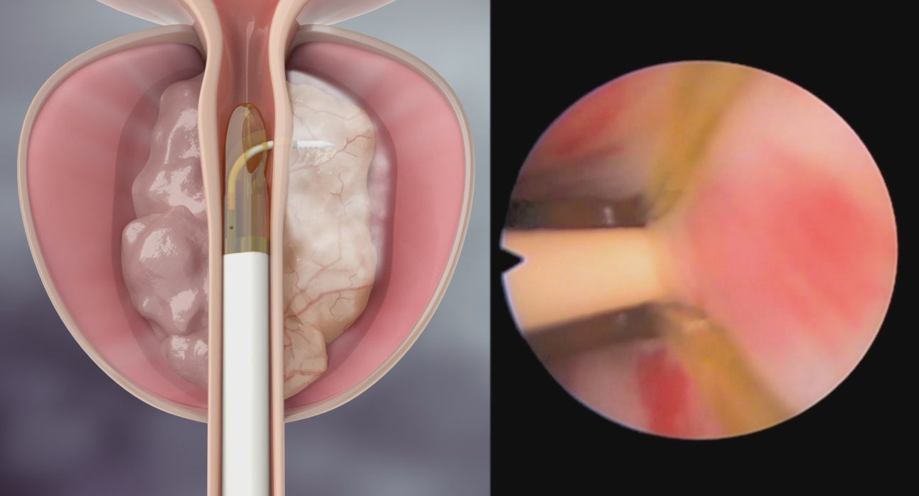 tratamento-de-prostata:-agora-disponivel-em-bauru